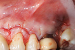 endodonzia fase3