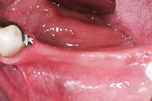 chirurgia_inlay fase1