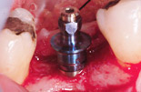 endodonzia fase3