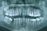 mucogengivale fase3