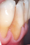 otturazioni estetiche fase1