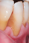 otturazioni estetiche fase2